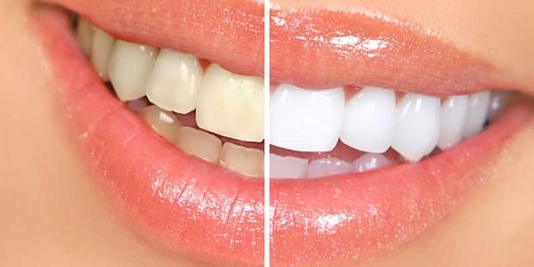 bleaching-vorher-nachher bleaching vorher nachher